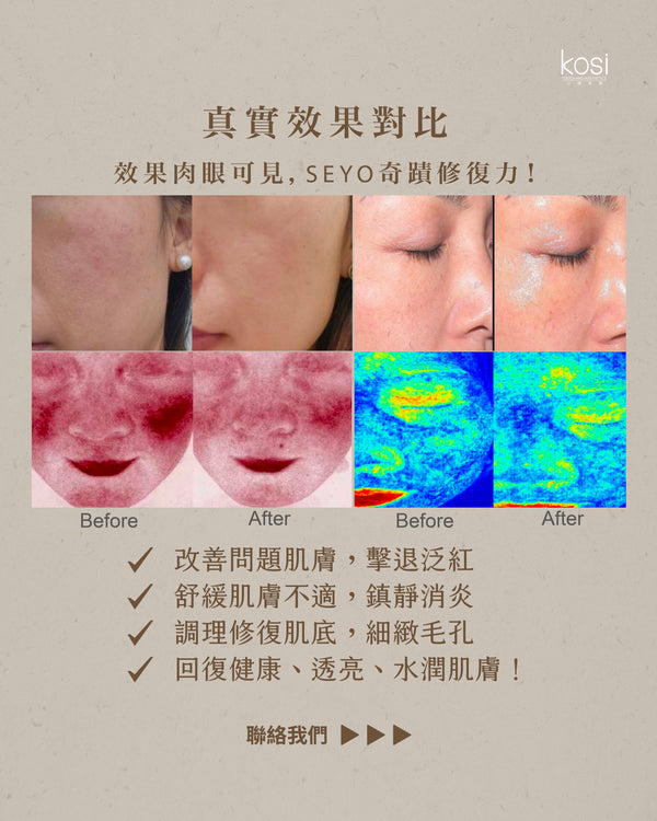 SEYO 無創注氧水光儀 - Proderm 抗敏修復療程(面部及頸部)