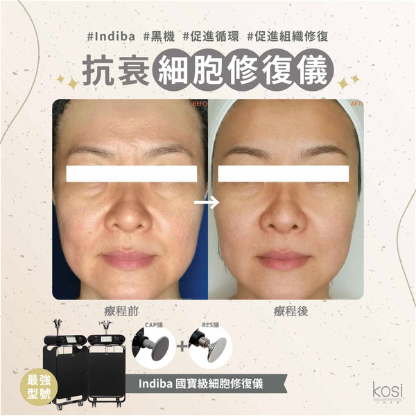 Indiba 國寶級細胞修復儀 - 內生熱抗衰老療程 (眼部)