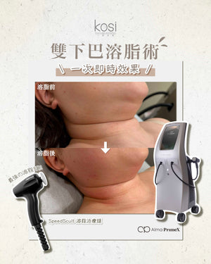 Alma PrimeX 超頻緊膚儀 - weewee聲超聲波雙下巴溶脂療程