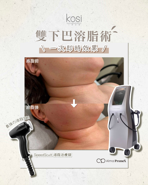 Alma PrimeX 超頻緊膚儀 - weewee聲超聲波雙下巴溶脂療程