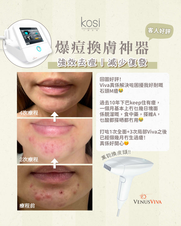 Venus Viva™ 再生換膚儀 - 強效局部去痘療程(局部)