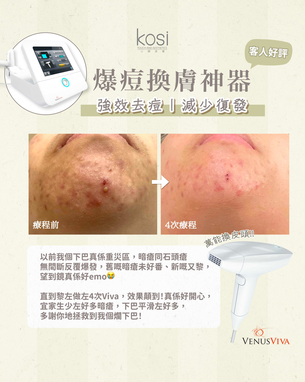 Venus Viva™ 再生換膚儀 - 強效局部去痘療程(局部)