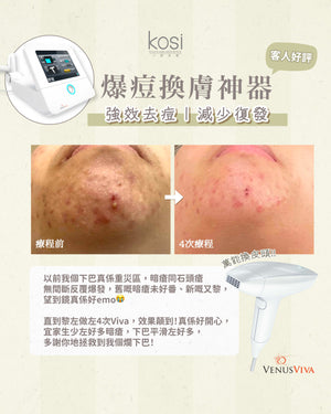 Venus Viva™ 再生換膚儀 - 強效局部去痘療程(局部)