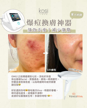 Venus Viva™ 再生換膚儀 - 強效局部去痘療程(局部)