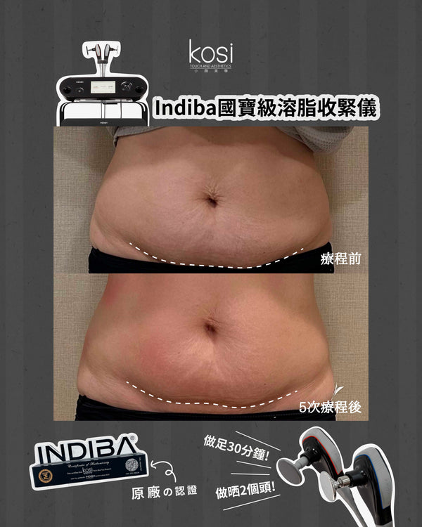 Indiba 國寶級溶脂收緊儀 - 內外夾擊減脂療程