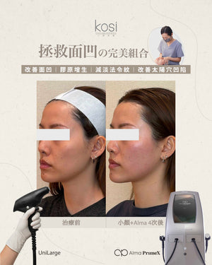 Alma PrimeX 超頻緊膚儀 - 煙花射頻泵泵漲療程(面部+眼周)