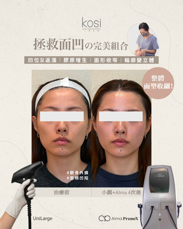 Kosi皇牌小顏整骨療程