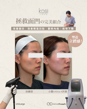 Alma PrimeX 超頻緊膚儀 - 煙花射頻泵泵漲療程(面部+眼周)