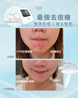 Venus Viva™ 再生換膚儀 - 強效局部去痘療程(局部)