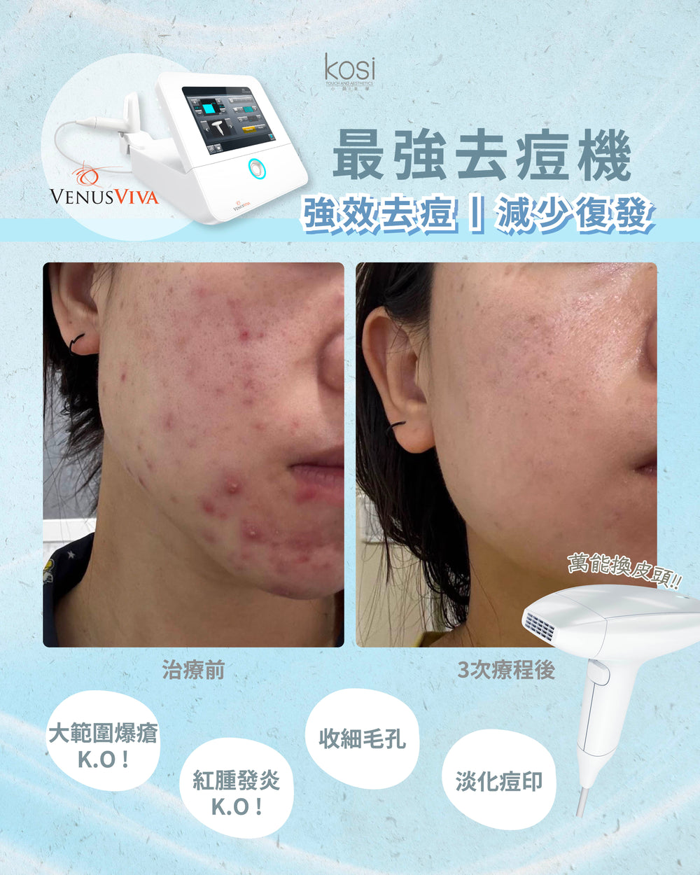 Venus Viva™ 再生換膚儀 - 淨痘/收毛孔去瑕療程(全面)