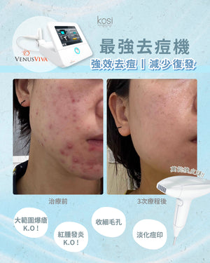Venus Viva™ 再生換膚儀 - 強效局部去痘療程(局部)