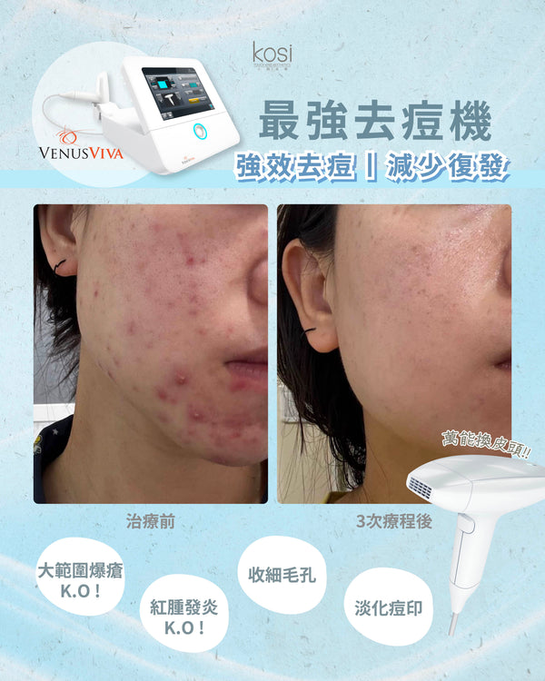Venus Viva™ 再生換膚儀 - 強效局部去痘療程(局部)