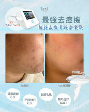 Venus Viva™ 再生換膚儀 - 強效局部去痘療程(局部)