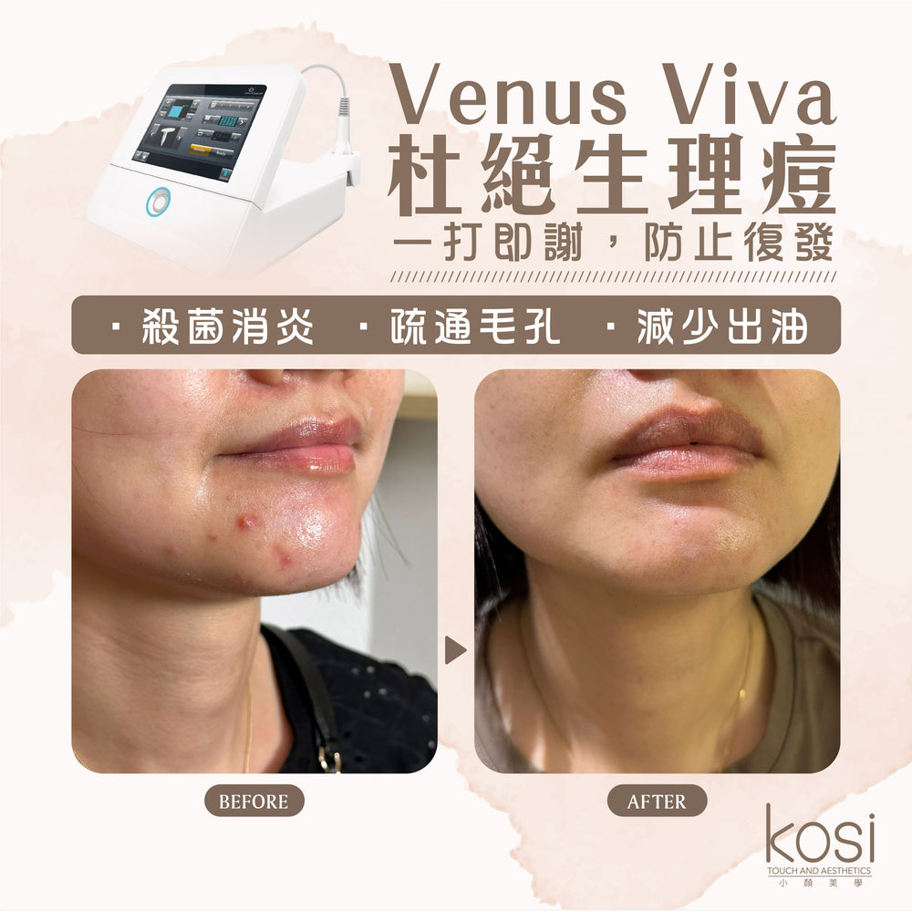 Venus Viva™ 再生換膚儀 - 強效局部去痘療程(去痘)