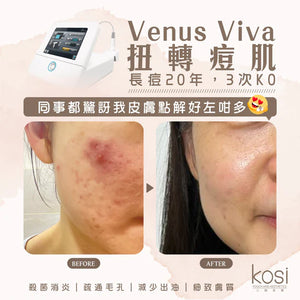 Venus Viva™ 再生換膚儀 - 淨痘/收毛孔去瑕療程(全面)