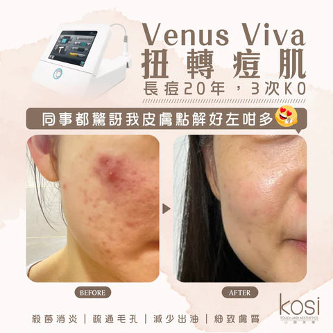 Venus Viva™ 再生換膚儀 - 淨痘/收毛孔去瑕療程(全面)
