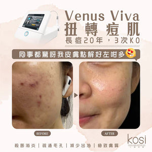 Venus Viva™ 再生換膚儀 - 淨痘/收毛孔去瑕療程(全面)