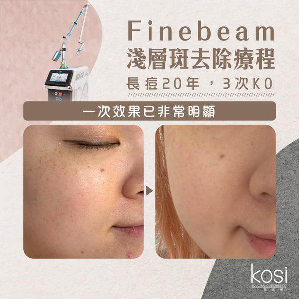 Finebeam激光 - 淺層斑去印療程