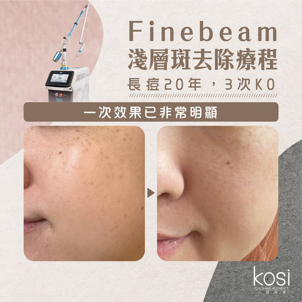 Finebeam激光 - 淺層斑去印療程