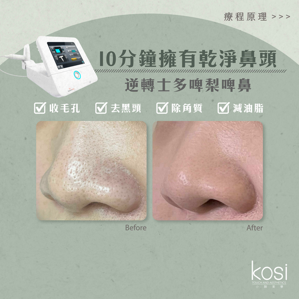 Venus Viva™ 再生換膚儀 - 鼻頭去黑頭/收毛孔療程(鼻)