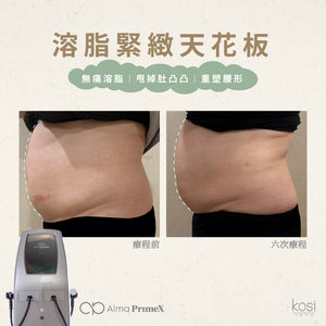 Alma PrimeX 超頻緊膚儀 - weewee聲超聲波身體溶脂療程
