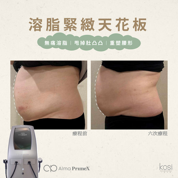 Alma PrimeX 超頻緊膚儀 - weewee聲超聲波身體溶脂療程