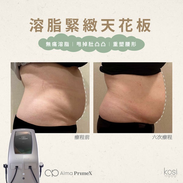 Alma PrimeX 超頻緊膚儀 - weewee聲超聲波身體溶脂療程