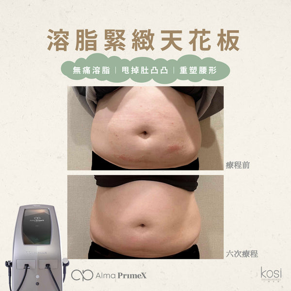 Alma PrimeX 超頻緊膚儀 - weewee聲超聲波身體溶脂療程