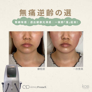 Alma PrimeX 超頻緊膚儀 - 煙花射頻泵泵漲療程(面部+眼周)