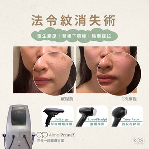 Alma PrimeX 超頻緊膚儀 - 煙花射頻泵泵漲療程(面部+眼周)