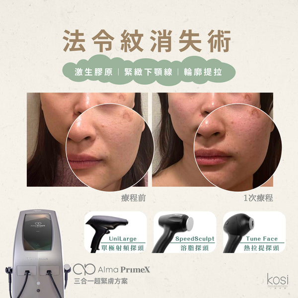 Alma PrimeX 超頻緊膚儀 - 煙花射頻泵泵漲療程(面部+眼周)