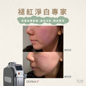 Derma V 褪紅淨白專家 - 不要面紅紅療程