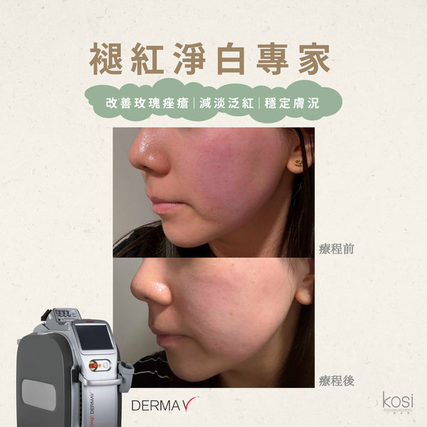 Derma V 褪紅淨白專家 - 不要面紅紅療程
