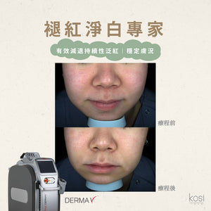 Derma V 褪紅淨白專家 - 不要面紅紅療程
