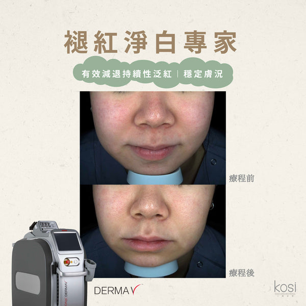 Derma V 褪紅淨白專家 - 不要面紅紅療程