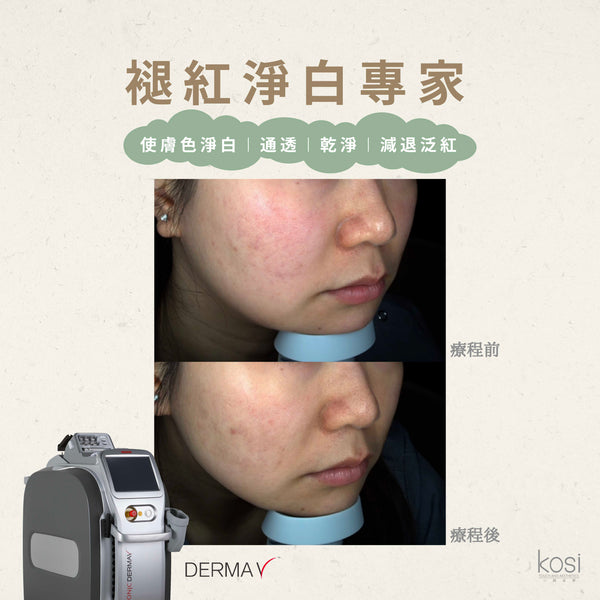 Derma V 褪紅淨白專家 - 不要面紅紅療程