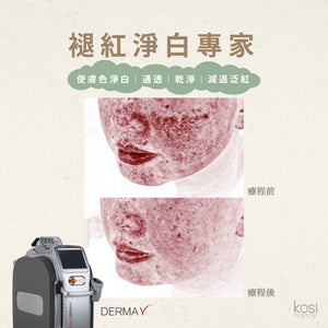 Derma V 褪紅淨白專家 - 不要面紅紅療程