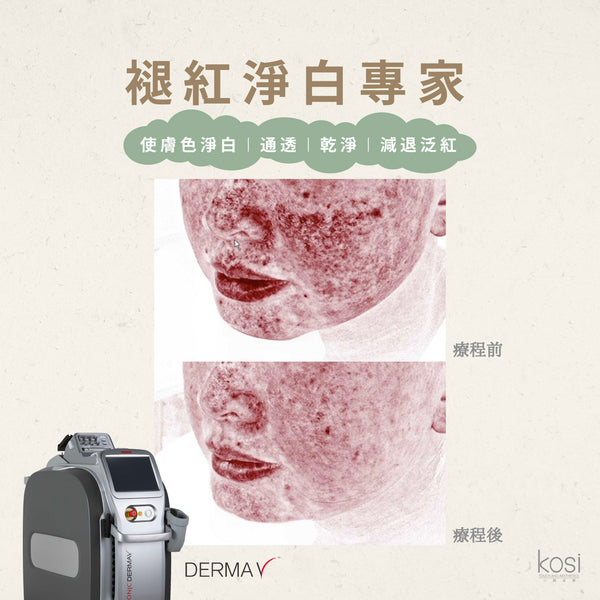 Derma V 褪紅淨白專家 - 不要面紅紅療程