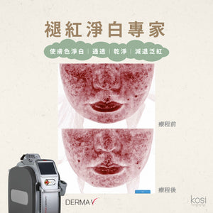 Derma V 褪紅淨白專家 - 不要面紅紅療程
