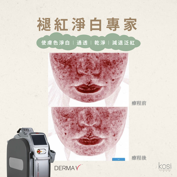 Derma V 褪紅淨白專家 - 不要面紅紅療程
