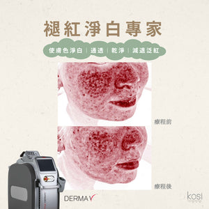 Derma V 褪紅淨白專家 - 不要面紅紅療程