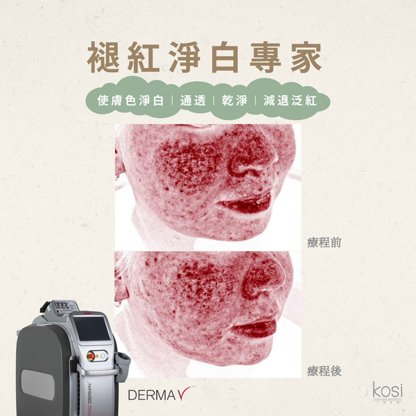 Derma V 褪紅淨白專家 - 不要面紅紅療程