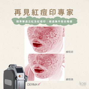 Derma V 褪紅淨白專家 - 再見紅痘印療程