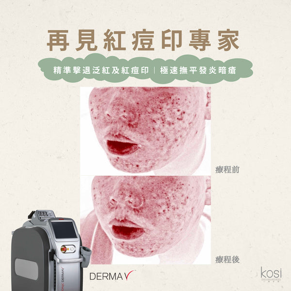 Derma V 褪紅淨白專家 - 再見紅痘印療程