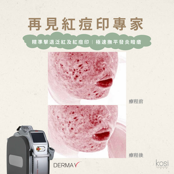 Derma V 褪紅淨白專家 - 再見紅痘印療程