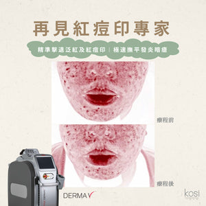 Derma V 褪紅淨白專家 - 再見紅痘印療程