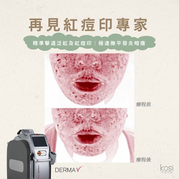 Derma V 褪紅淨白專家 - 再見紅痘印療程