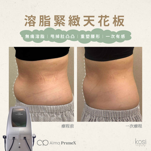 Alma PrimeX 超頻緊膚儀 - weewee聲超聲波身體溶脂療程