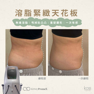 Alma PrimeX 超頻緊膚儀 - weewee聲超聲波身體溶脂療程