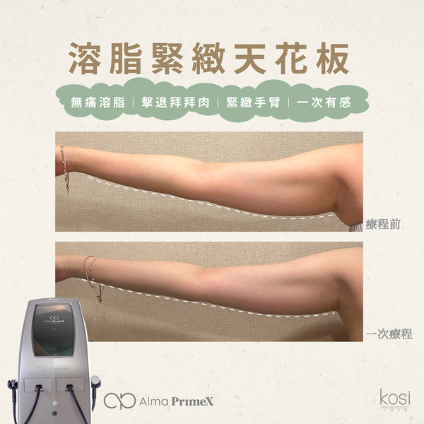 Alma PrimeX 超頻緊膚儀 - weewee聲超聲波身體溶脂療程